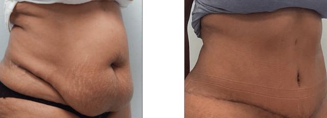 Tummy Tuck result at Fort Lauderdale Plastic Surgery in Fort Lauderdale, FL