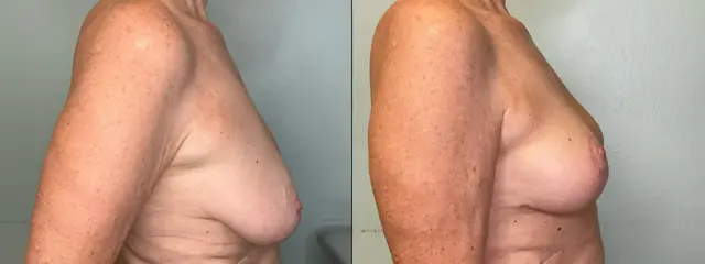 Breast Lift result at Fort Lauderdale Plastic Surgery in Fort Lauderdale, FL