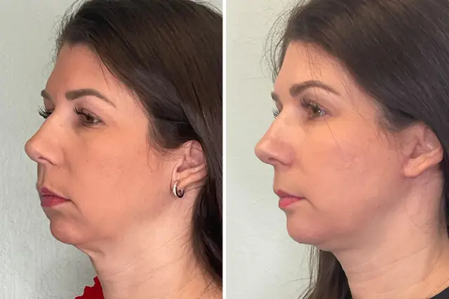 Chin Implant result at Fort Lauderdale Plastic Surgery in Fort Lauderdale, FL