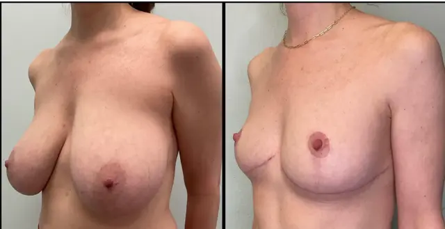 Breast Reduction result at Fort Lauderdale Plastic Surgery in Fort Lauderdale, FL