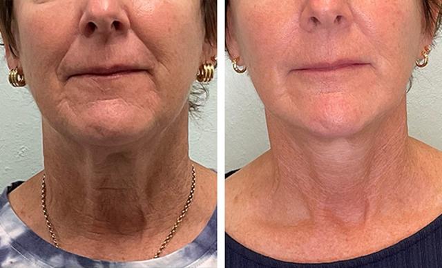 Mini Facelift result at Fort Lauderdale Plastic Surgery in Fort Lauderdale, FL