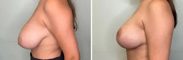 Breast Reduction result at Fort Lauderdale Plastic Surgery in Fort Lauderdale, FL