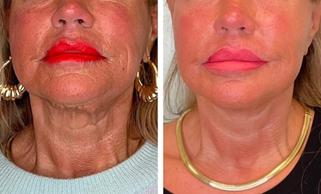 Mini Facelift result at Fort Lauderdale Plastic Surgery in Fort Lauderdale, FL