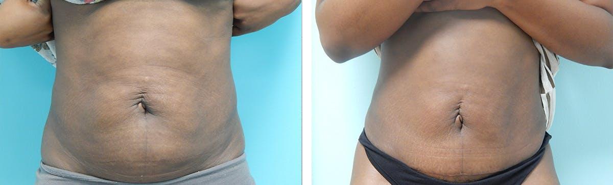 Fort Lauderdale Plastic Surgery tummy tuck result — Fort Lauderdale, FL