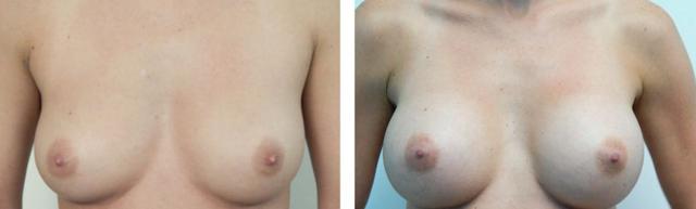 Breast Augmentation result at Fort Lauderdale Plastic Surgery in Fort Lauderdale, FL