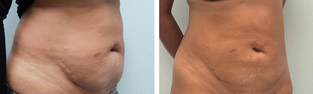 Liposuction result at Fort Lauderdale Plastic Surgery in Fort Lauderdale, FL