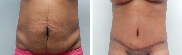 Liposuction result at Fort Lauderdale Plastic Surgery in Fort Lauderdale, FL