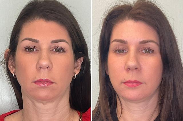 Chin Implant result at Fort Lauderdale Plastic Surgery in Fort Lauderdale, FL