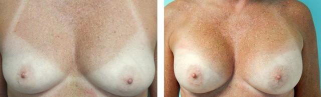 Breast Augmentation result at Fort Lauderdale Plastic Surgery in Fort Lauderdale, FL