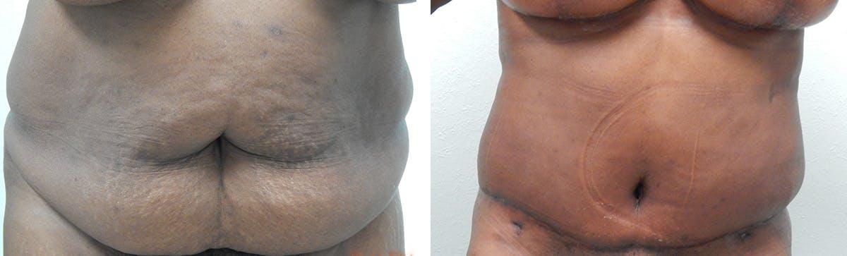 Fort Lauderdale Plastic Surgery tummy tuck result — Fort Lauderdale, FL
