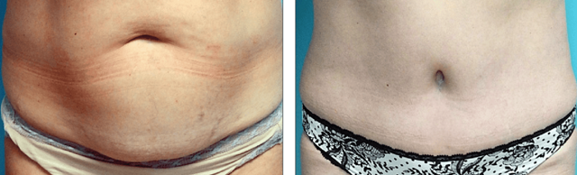 Tummy Tuck result at Fort Lauderdale Plastic Surgery in Fort Lauderdale, FL