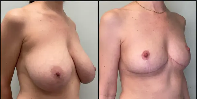 Breast Lift result at Fort Lauderdale Plastic Surgery in Fort Lauderdale, FL