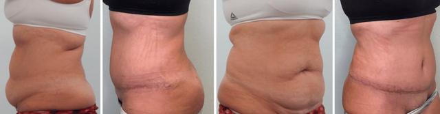 Tummy Tuck result at Fort Lauderdale Plastic Surgery in Fort Lauderdale, FL