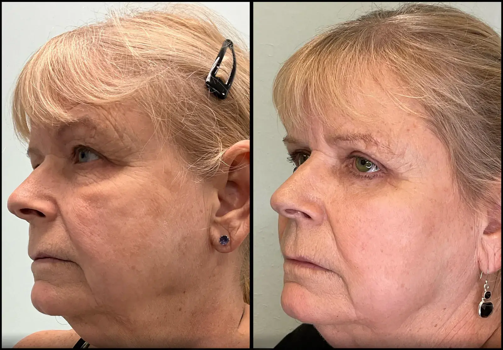 Fort Lauderdale Plastic Surgery eyelid lift result — Fort Lauderdale, FL