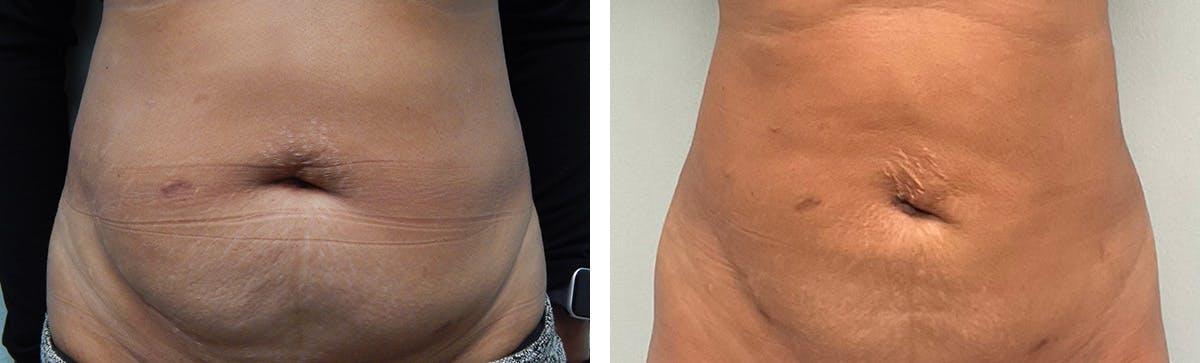 Fort Lauderdale Plastic Surgery tummy tuck result — Fort Lauderdale, FL