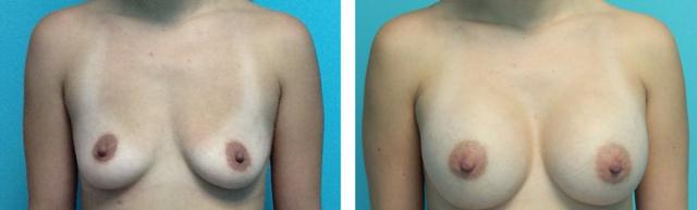 Breast Augmentation result at Fort Lauderdale Plastic Surgery in Fort Lauderdale, FL