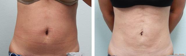 Liposuction result at Fort Lauderdale Plastic Surgery in Fort Lauderdale, FL