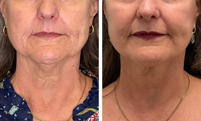 Neck Lift result at Fort Lauderdale Plastic Surgery in Fort Lauderdale, FL