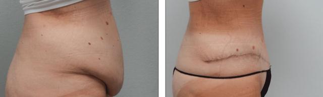 Tummy Tuck result at Fort Lauderdale Plastic Surgery in Fort Lauderdale, FL