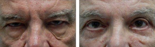 Blepharoplasty result at Fort Lauderdale Plastic Surgery in Fort Lauderdale, FL
