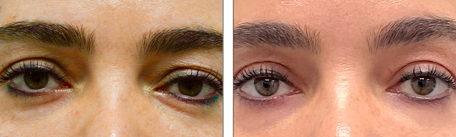 Blepharoplasty result at Fort Lauderdale Plastic Surgery in Fort Lauderdale, FL