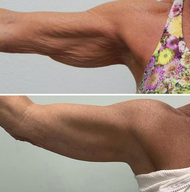 Arm Lift result at Fort Lauderdale Plastic Surgery in Fort Lauderdale, FL