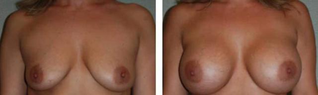 Breast Augmentation result at Fort Lauderdale Plastic Surgery in Fort Lauderdale, FL