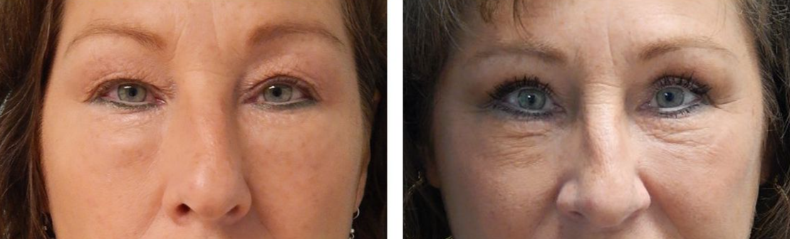 Fort Lauderdale Plastic Surgery blepharoplasty result — Fort Lauderdale, FL