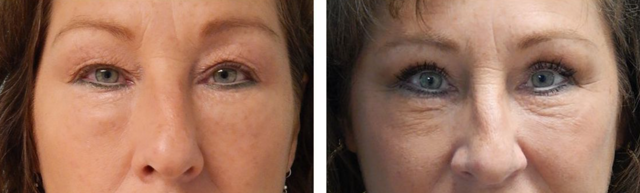 Blepharoplasty result at Fort Lauderdale Plastic Surgery in Fort Lauderdale, FL