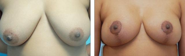 Breast Lift result at Fort Lauderdale Plastic Surgery in Fort Lauderdale, FL