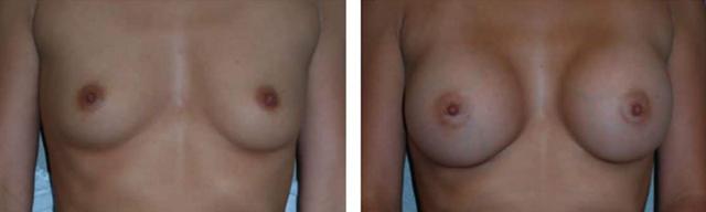 Breast Augmentation result at Fort Lauderdale Plastic Surgery in Fort Lauderdale, FL