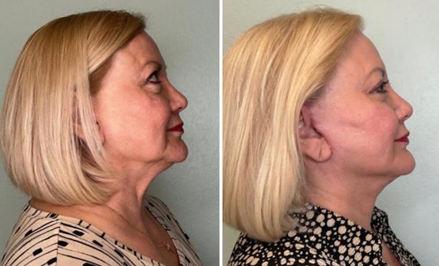 Mini Facelift result at Fort Lauderdale Plastic Surgery in Fort Lauderdale, FL