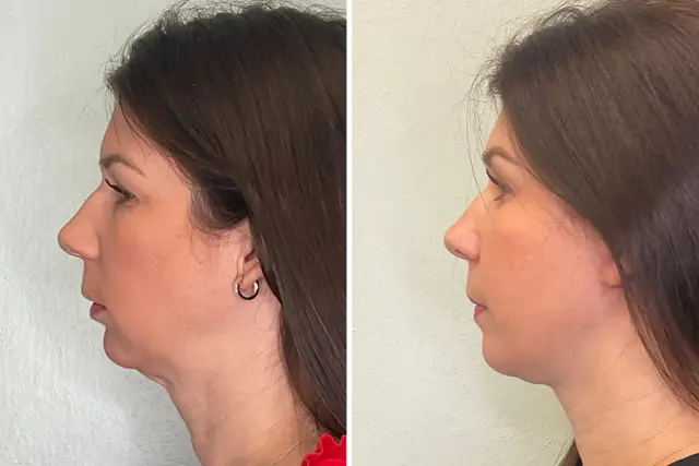 Chin Implant result at Fort Lauderdale Plastic Surgery in Fort Lauderdale, FL
