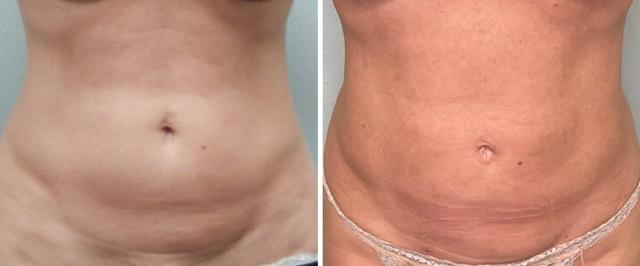 Liposuction result at Fort Lauderdale Plastic Surgery in Fort Lauderdale, FL