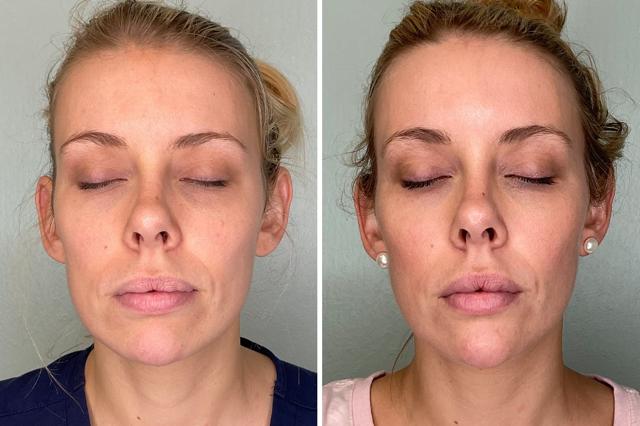 Chin Implant result at Fort Lauderdale Plastic Surgery in Fort Lauderdale, FL