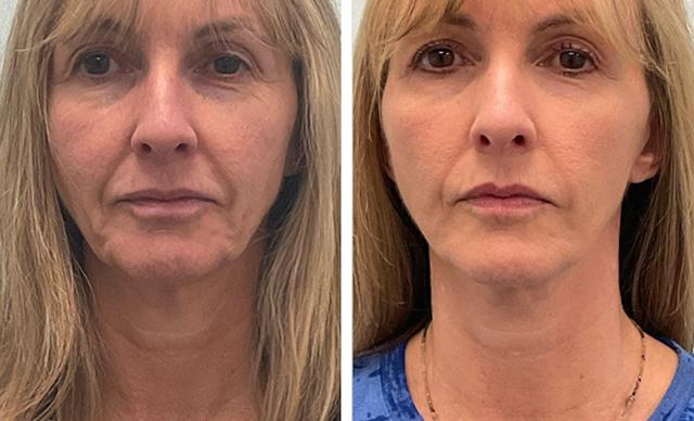 Mini Facelift result at Fort Lauderdale Plastic Surgery in Fort Lauderdale, FL