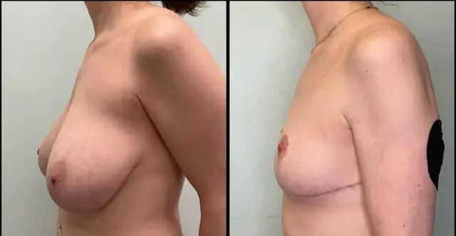 Breast Reduction result at Fort Lauderdale Plastic Surgery in Fort Lauderdale, FL
