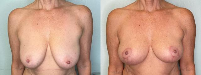 Breast Lift result at Fort Lauderdale Plastic Surgery in Fort Lauderdale, FL