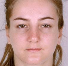 Rhinoplasty after at Hankins & Sohn Plastic Surgery Associates in Henderson, NV