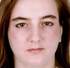 Rhinoplasty before at Hankins & Sohn Plastic Surgery Associates in Henderson, NV