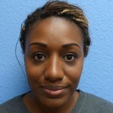 Rhinoplasty after at Hankins & Sohn Plastic Surgery Associates in Las Vegas, NV