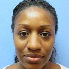 Rhinoplasty before at Hankins & Sohn Plastic Surgery Associates in Las Vegas, NV