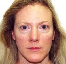 Rhinoplasty after at Hankins & Sohn Plastic Surgery Associates in Henderson, NV
