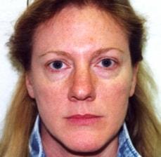 Rhinoplasty before at Hankins & Sohn Plastic Surgery Associates in Henderson, NV