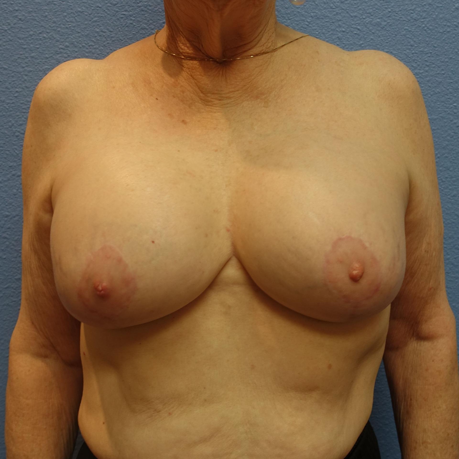Hankins & Sohn Plastic Surgery Associates breast lift after — Henderson, NV