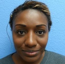 Hankins & Sohn Plastic Surgery Associates rhinoplasty after — Las Vegas, NV