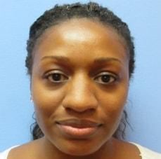 Rhinoplasty before at Hankins & Sohn Plastic Surgery Associates in Henderson, NV