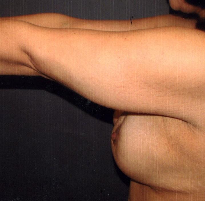Hankins & Sohn Plastic Surgery Associates arm lift after — Henderson, NV