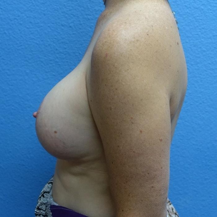 Hankins & Sohn Plastic Surgery Associates breast lift after — Henderson, NV