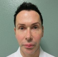 Rhinoplasty after at Hankins & Sohn Plastic Surgery Associates in Henderson, NV